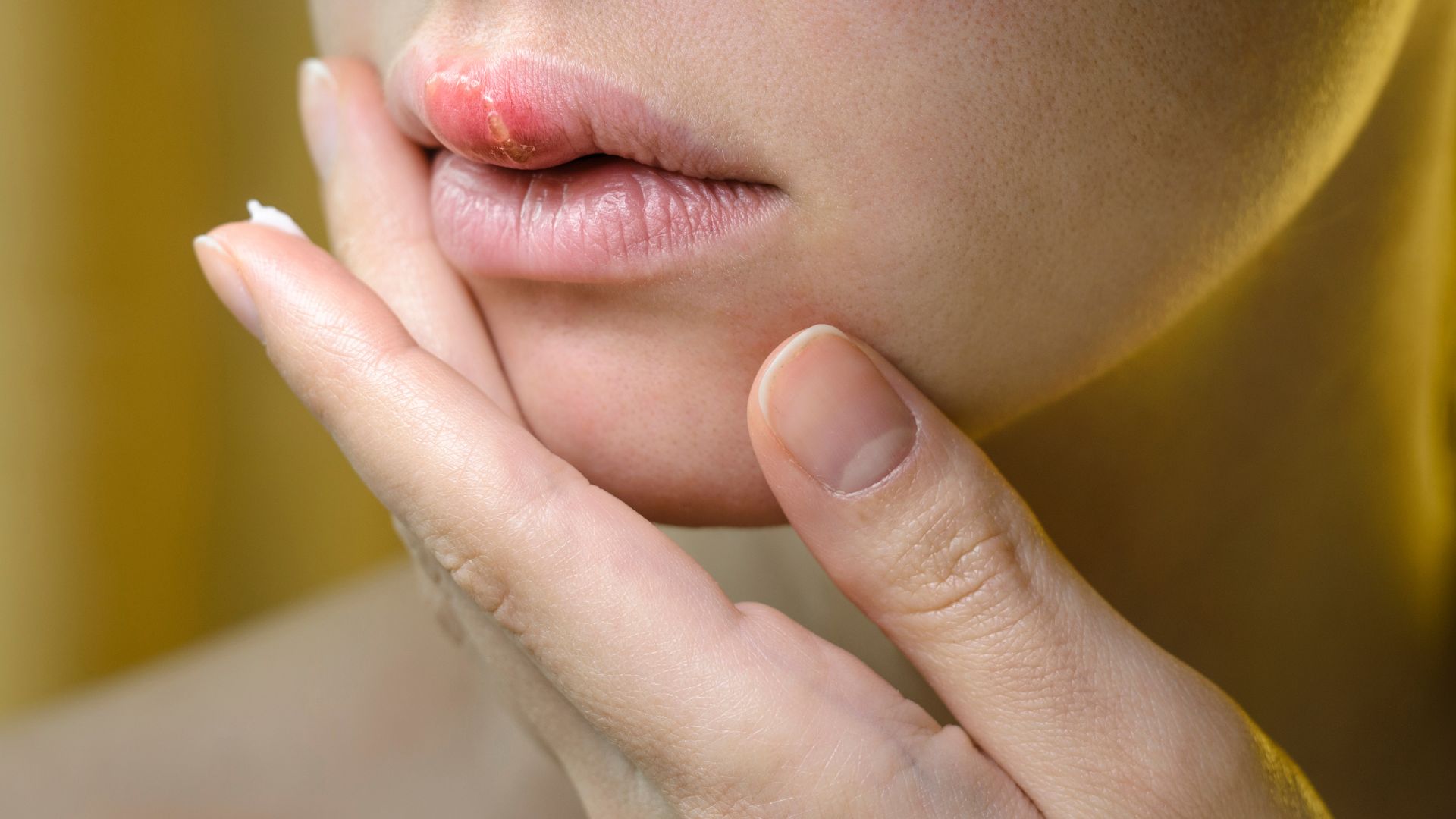 Trong viêm môi u hạt, sưng môi là dấu hiệu đặc trưng nhất, thường gặp ở môi trên, môi dưới hoặc cả hai