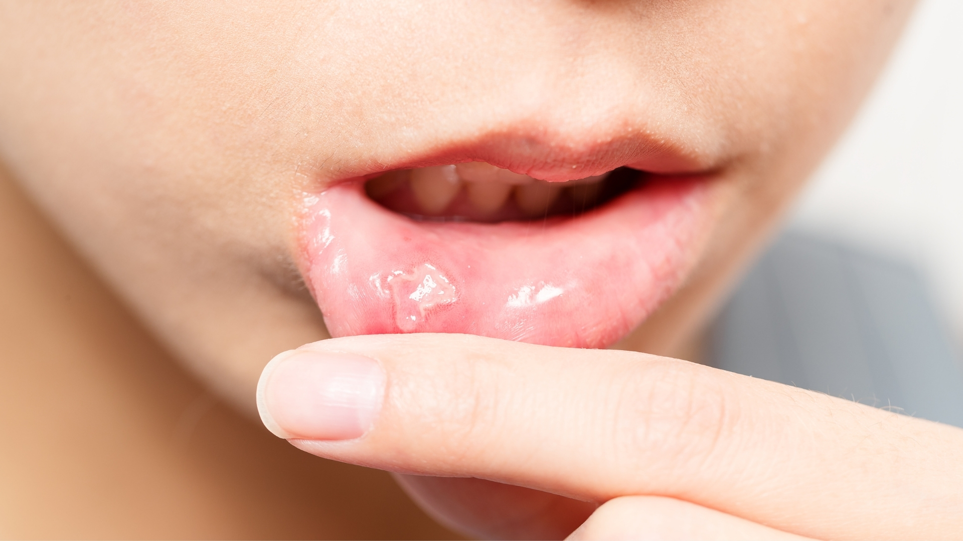 Ở giai đoạn tiến triển, niêm mạc có thể xuất hiện các vết loét nông hoặc sâu, gây đau nhiều