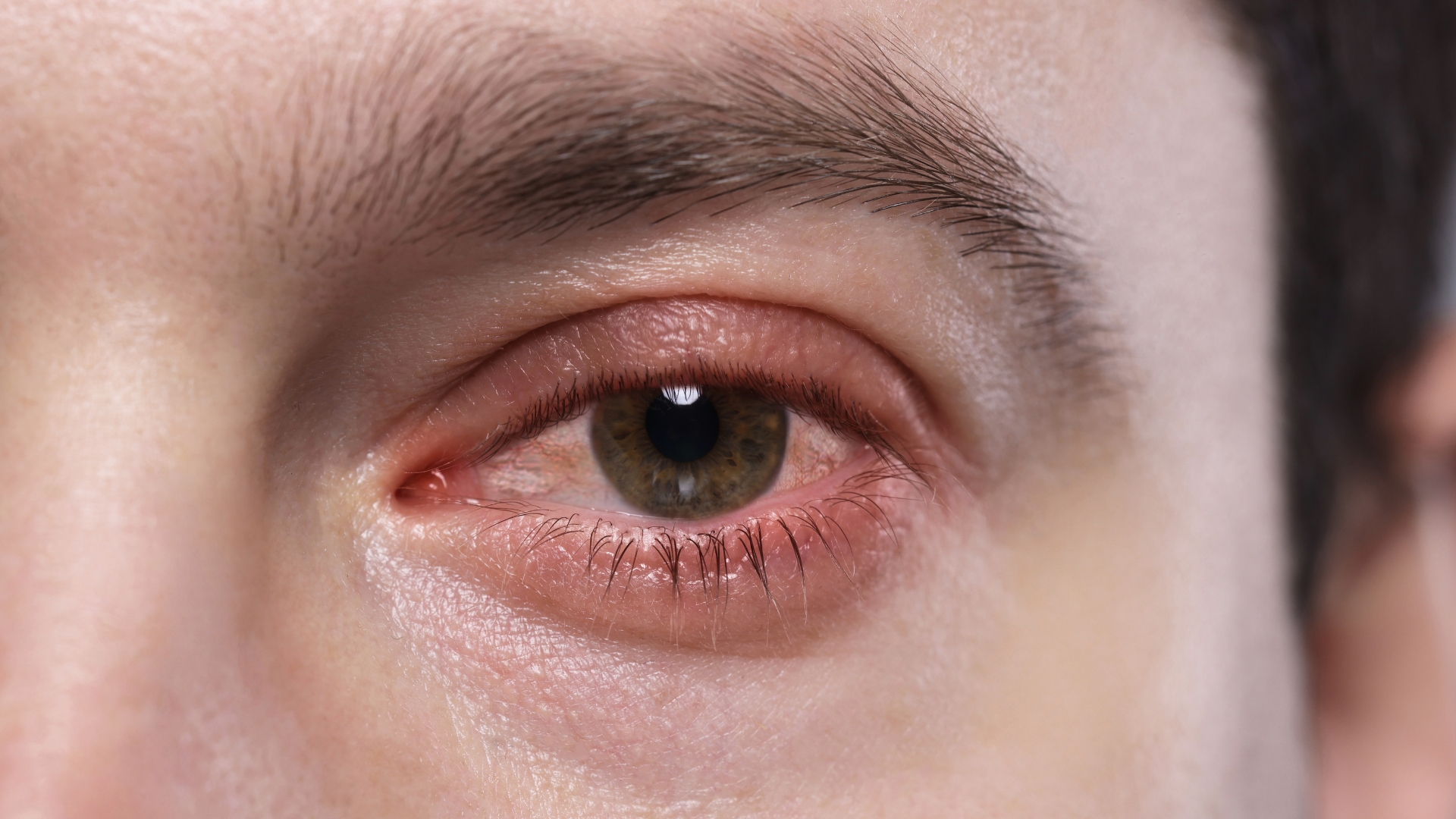 Trong các trường hợp viêm lan rộng hoặc kết hợp với viêm màng bồ đào, mắt có thể đỏ, kèm theo chảy nước mắt