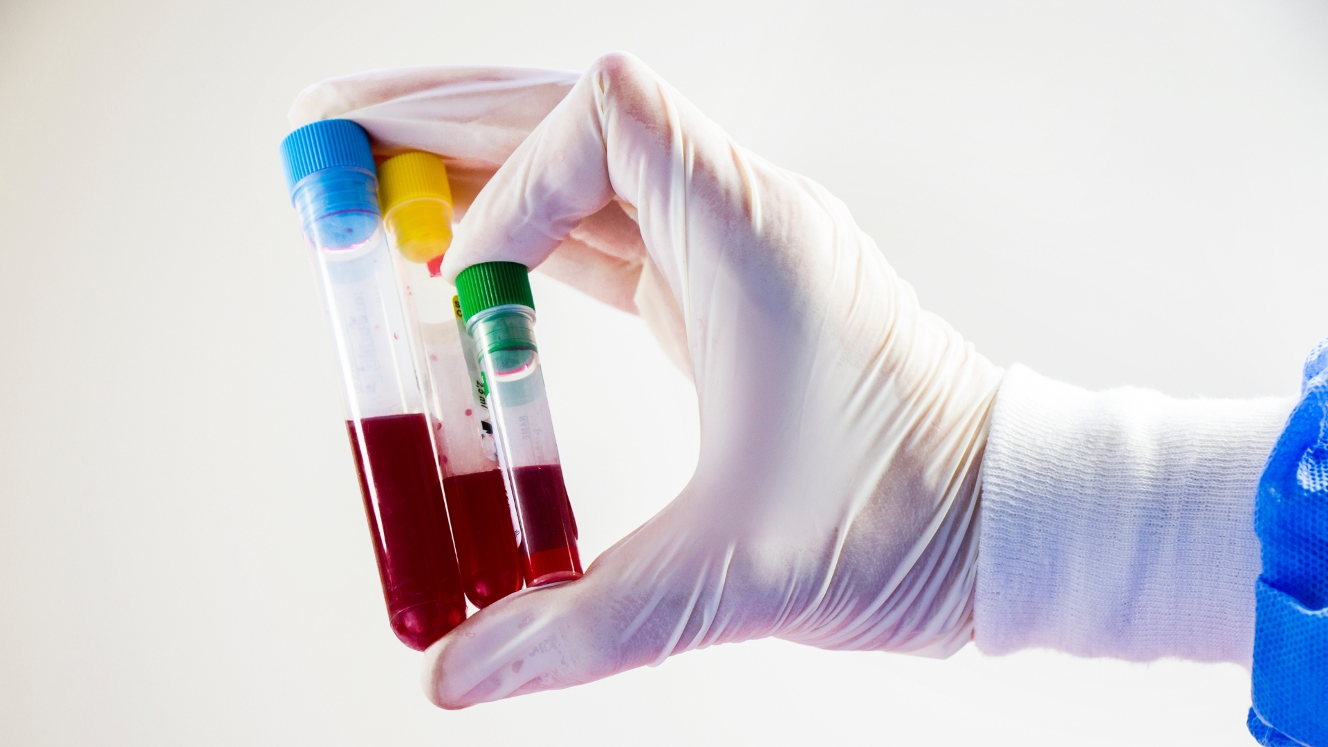 Các xét nghiệm như lipid máu, đường huyết, HbA1c giúp đánh giá các yếu tố nguy cơ liên quan đến xơ vữa động mạch