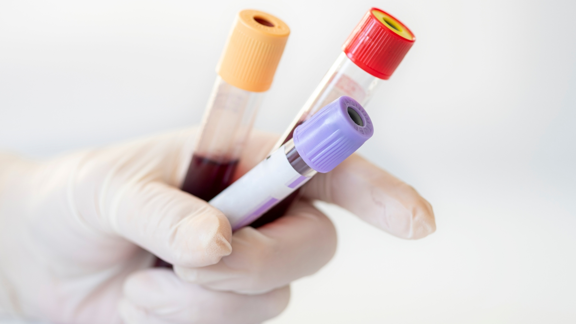 Các xét nghiệm máu đóng vai trò hỗ trợ trong chẩn đoán và đánh giá nguy cơ