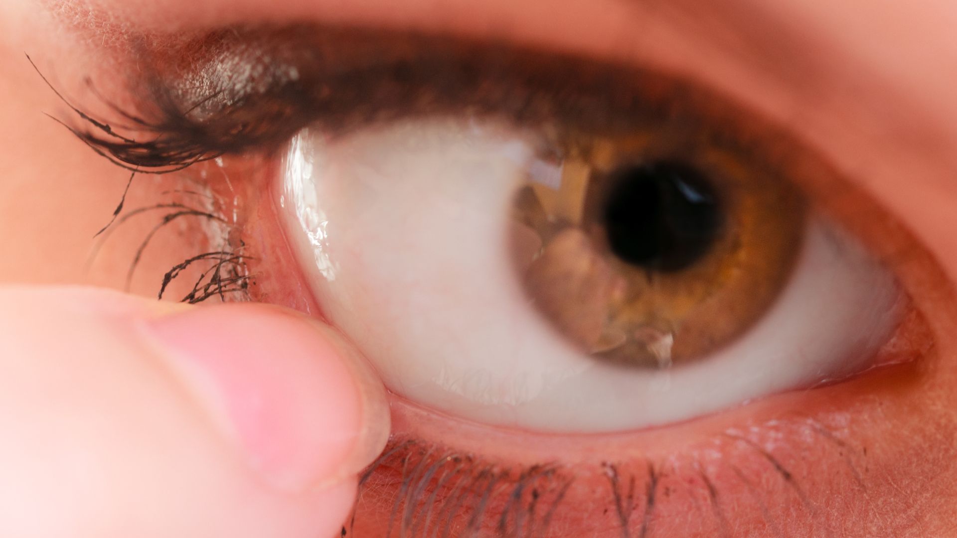 Dị vật bay vào mắt có thể bám vào bề mặt giác mạc và gây trầy xước khi mắt chớp