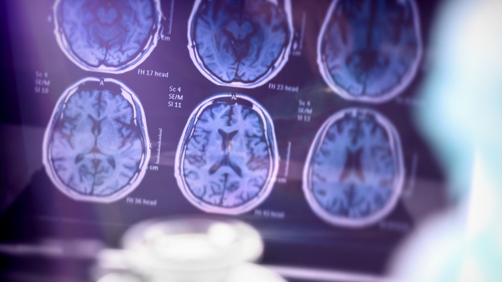 Sử dụng các phương pháp chẩn đoán hình ảnh như chụp CT hoặc MRI sọ não