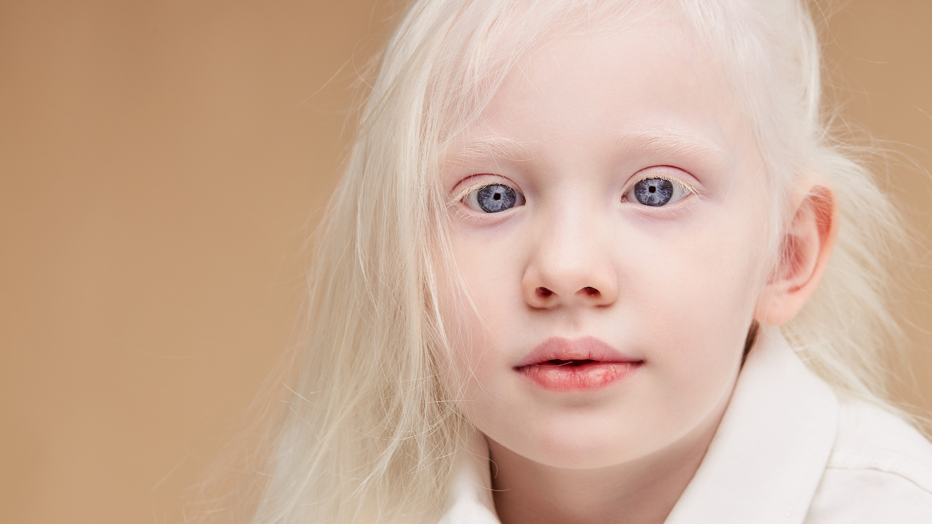 Bạch tạng là một rối loạn di truyền đặc trưng bởi sự suy giảm hoặc thiếu hụt melanin, sắc tố quyết định màu da, tóc và mắt