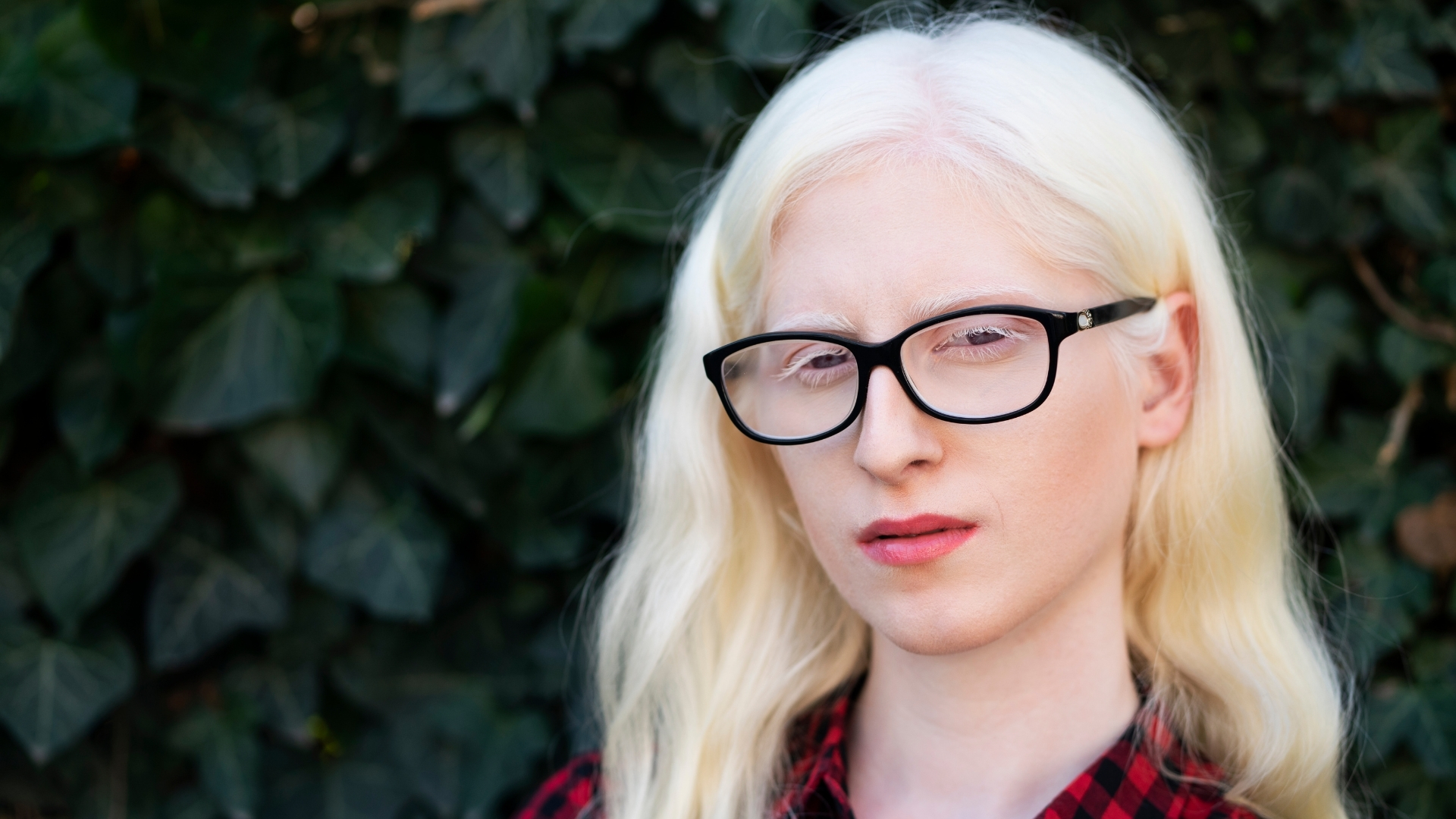 Rối loạn thị giác là một trong những đặc điểm phổ biến của bệnh bạch tạng