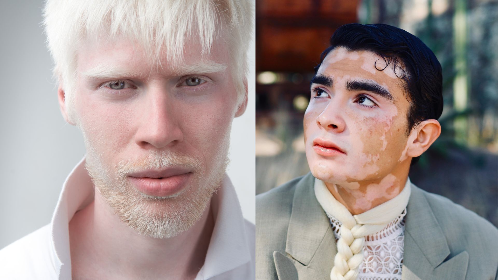 Bệnh bạch tạng và bạch biến có nhiều điểm khác nhau