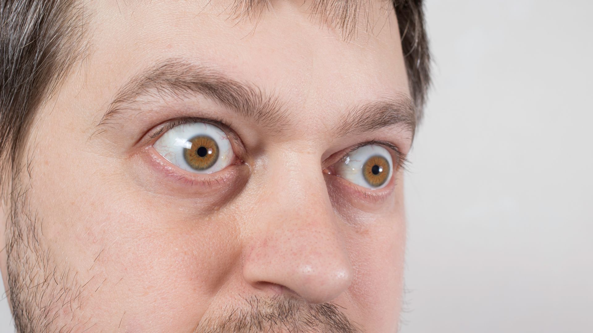 Lồi mắt là một trong những triệu chứng điển hình của bệnh Basedow