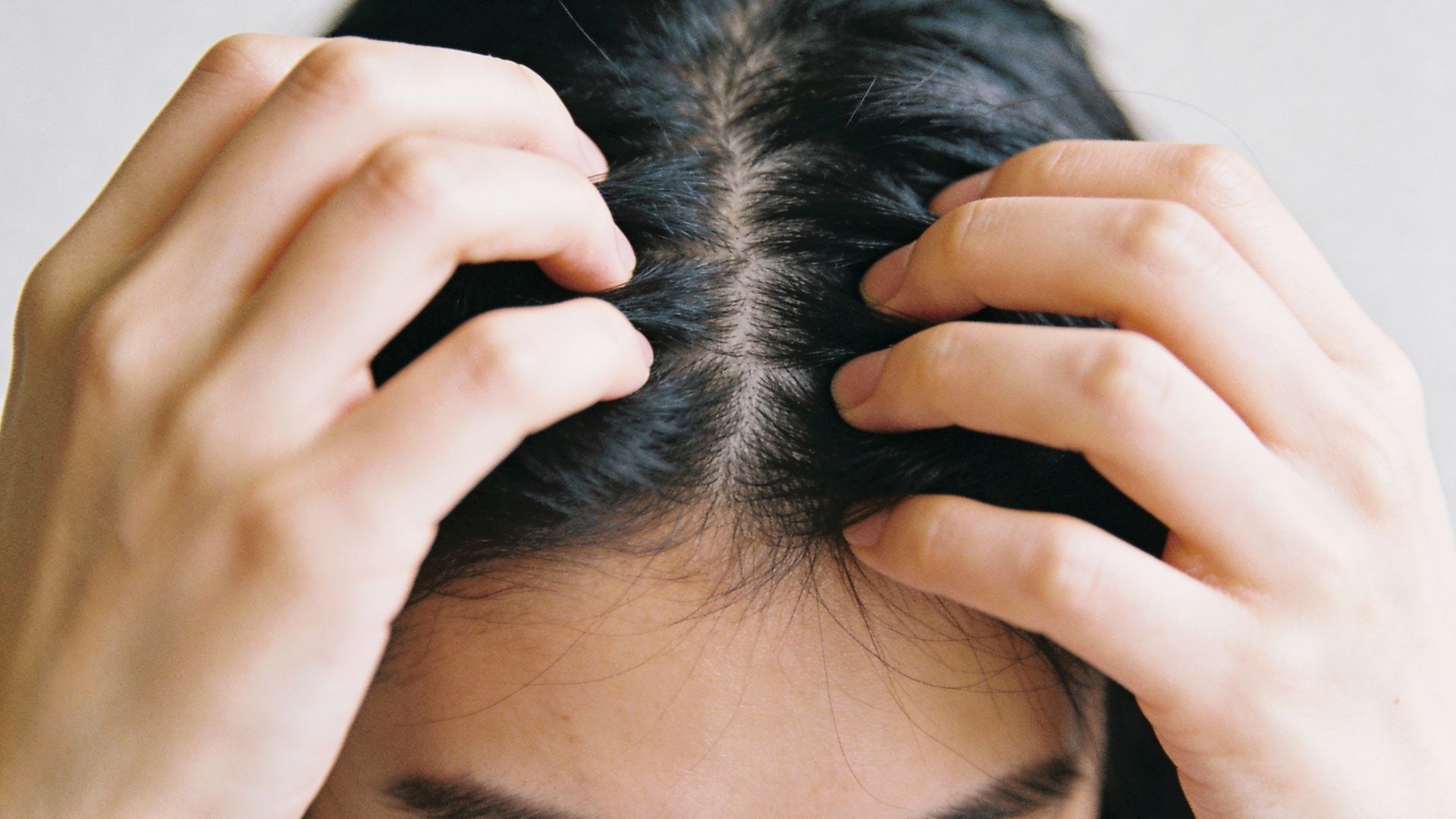 Da đầu bong tróc và khô là biểu hiện thường gặp khi da bị kích ứng kéo dài