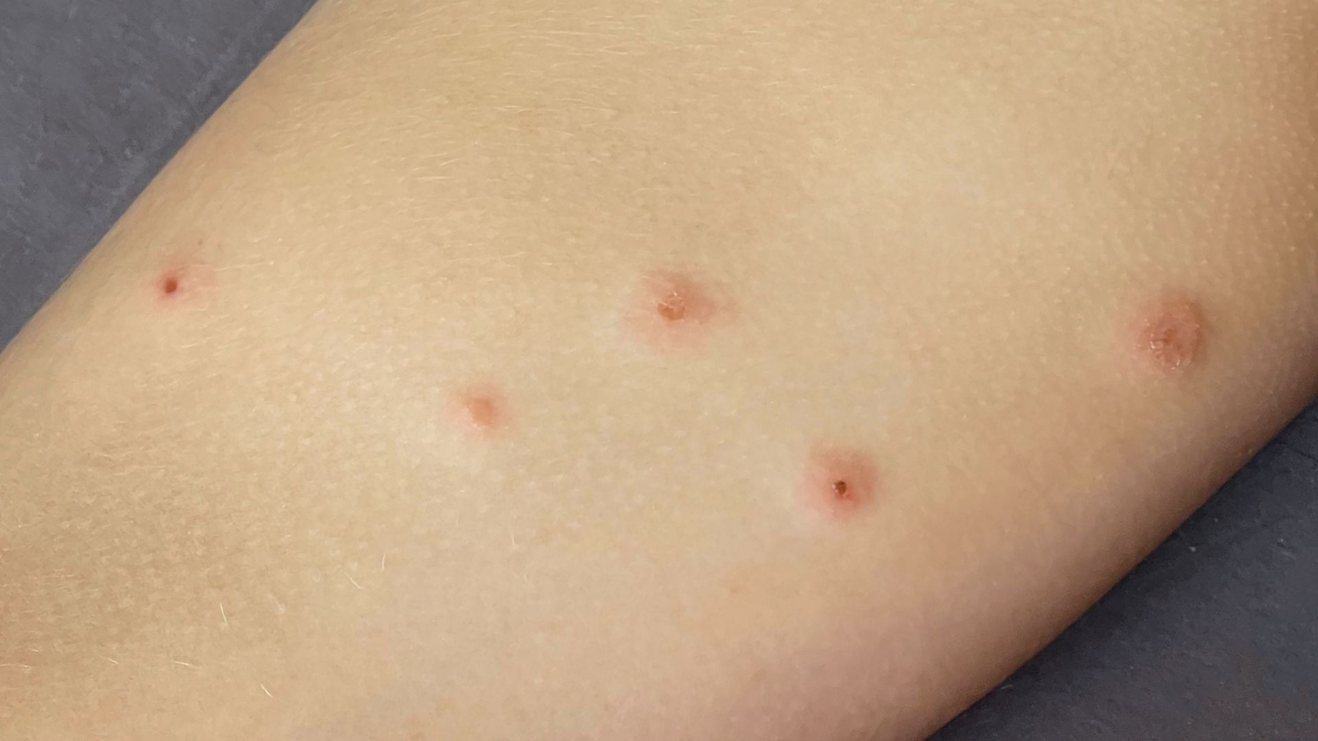Bệnh chốc lở bao lâu thì khỏi và cách điều trị hiệu quả-2