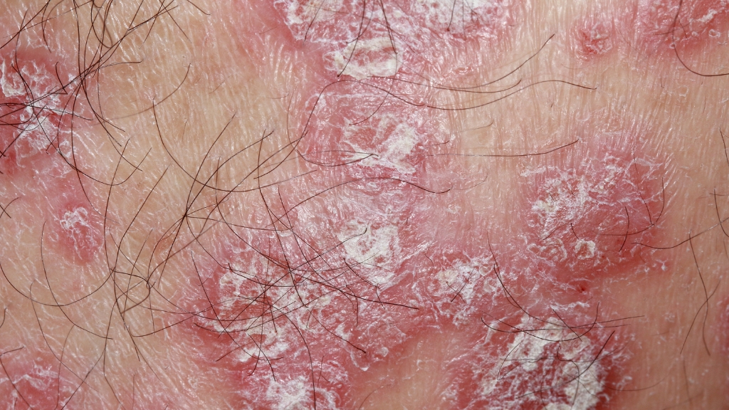 Tìm hiểu bệnh da do nấm sợi là gì