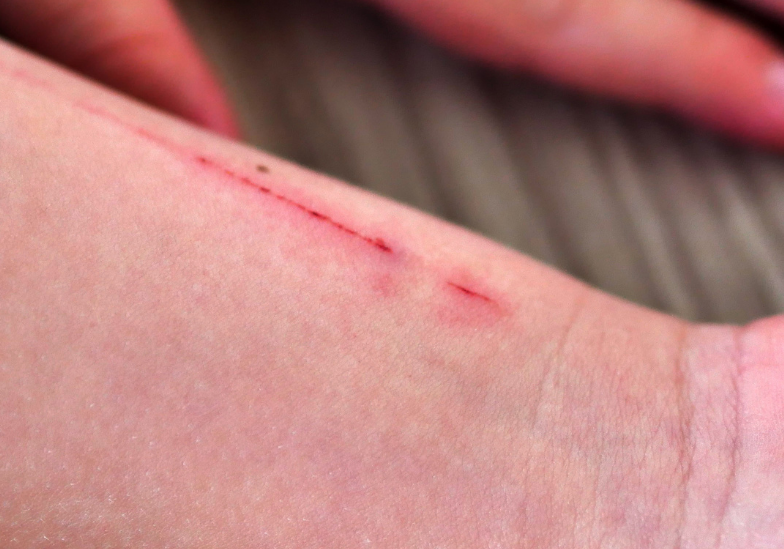 benh-dai-co-lay-tu-nguoi-sang-nguoi-khong 3.png