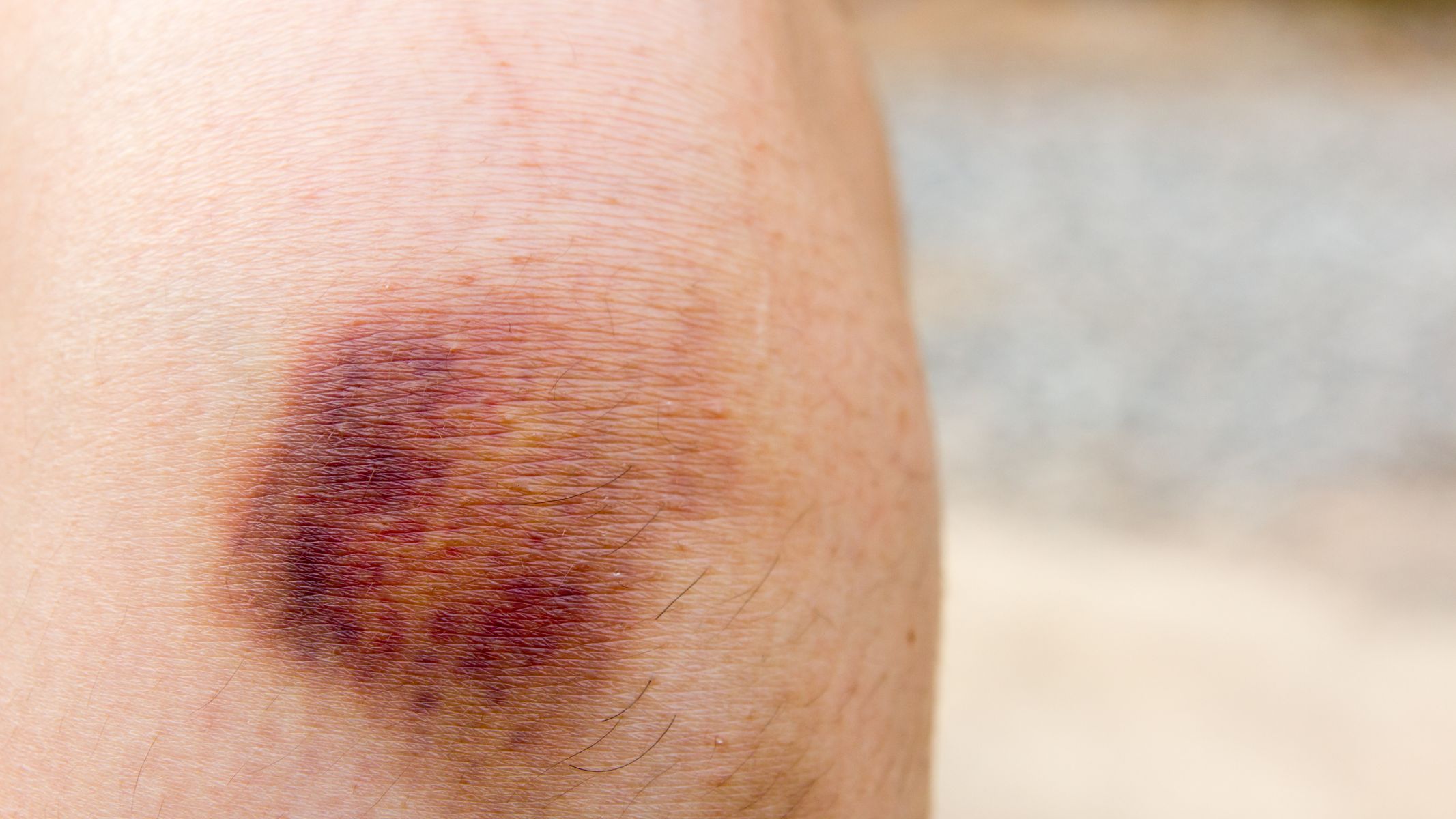 Người bệnh dễ bầm tím bất thường dù không va chạm rõ ràng