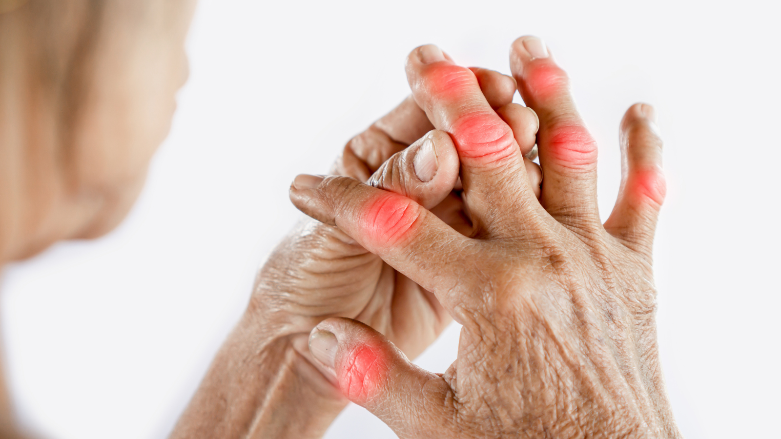 Bệnh gút có chữa khỏi được không? Câu trả lời là không thể chữa khỏi hoàn toàn