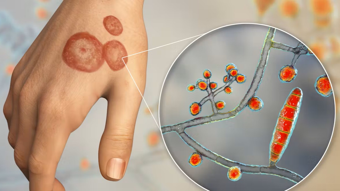 Bệnh hắc lào​ là gì? Triệu chứng và phương pháp điều trị 2.jpg