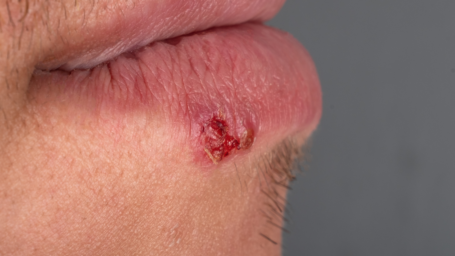 Nếu hệ miễn dịch suy yếu, các biểu hiện herpes môi có thể nhanh chóng xuất hiện lại