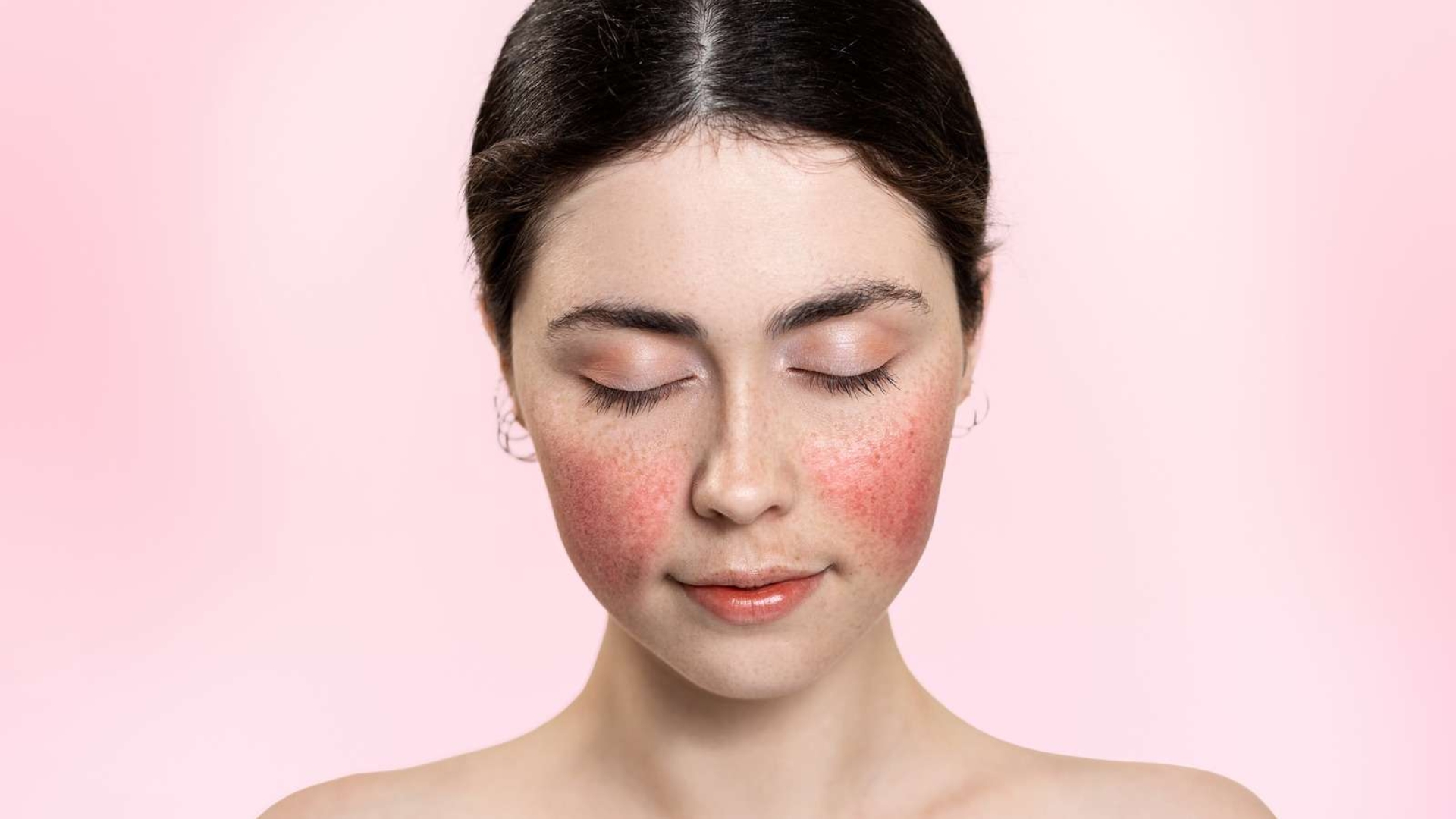 Bệnh lupus ban đỏ có lây không? Câu trả lời là không