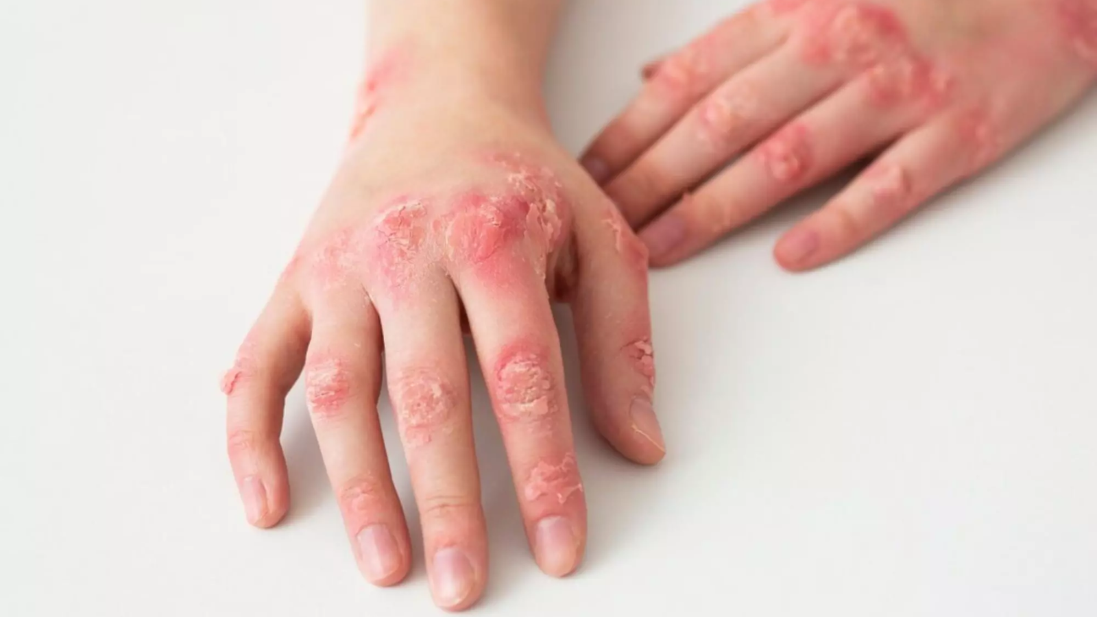 Bệnh lupus ban đỏ có nguy hiểm không? Những biến chứng nguy hiểm của bệnh 2
