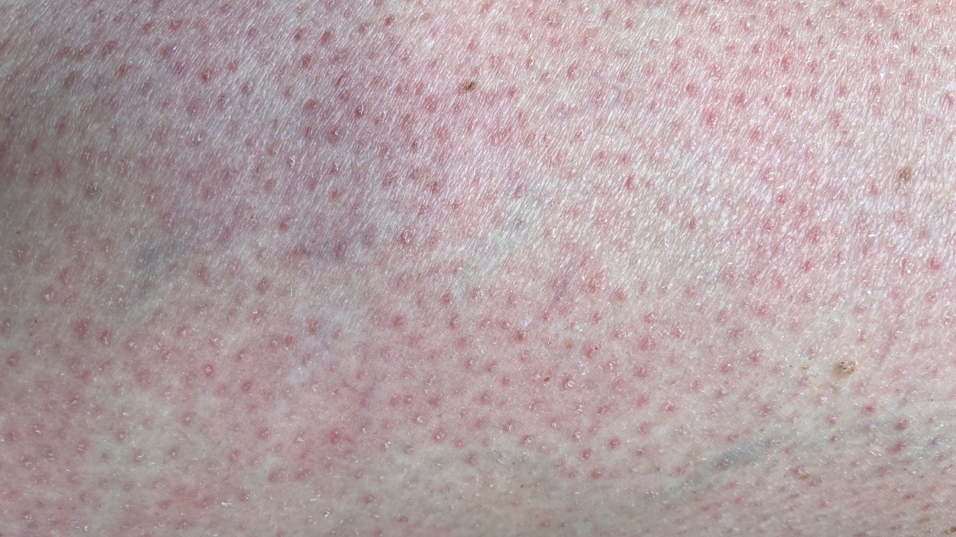 Bệnh lupus ban đỏ giai đoạn cuối: Các biến chứng nguy hiểm và cách chăm sóc hiệu quả 2