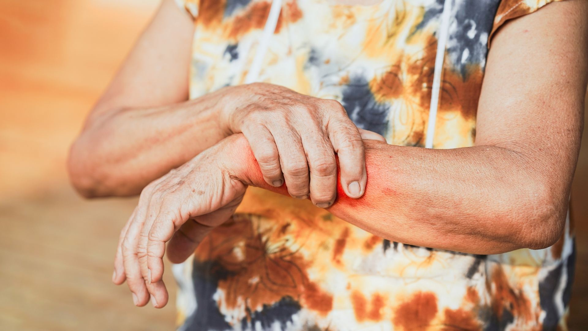 Bệnh lupus ban đỏ giai đoạn đầu: Dấu hiệu, chẩn đoán và điều trị 2