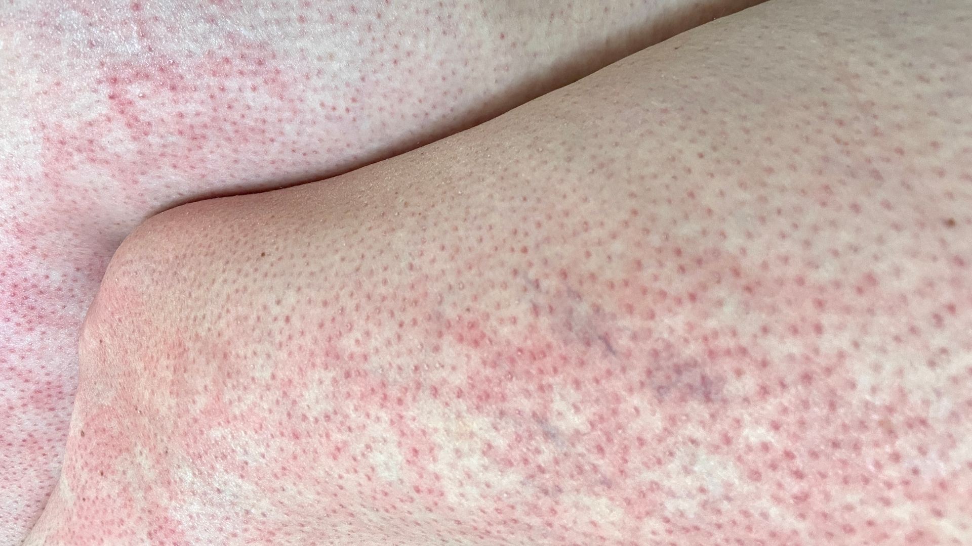 Bệnh lupus ban đỏ sống được bao lâu? Sự thật và yếu tố quyết định tuổi thọ 3