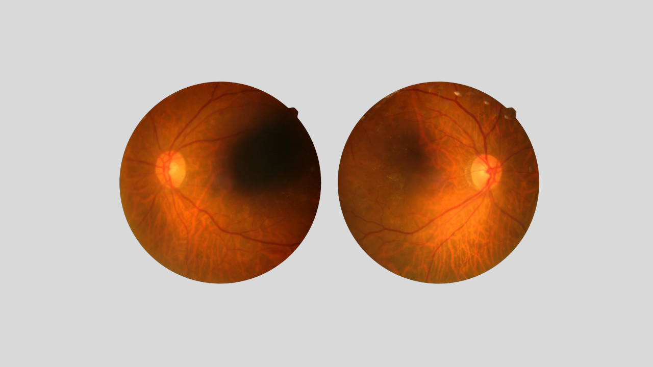 Bệnh lý võng mạc ở trẻ sinh non (ROP) là một rối loạn phát triển mạch máu của võng mạc