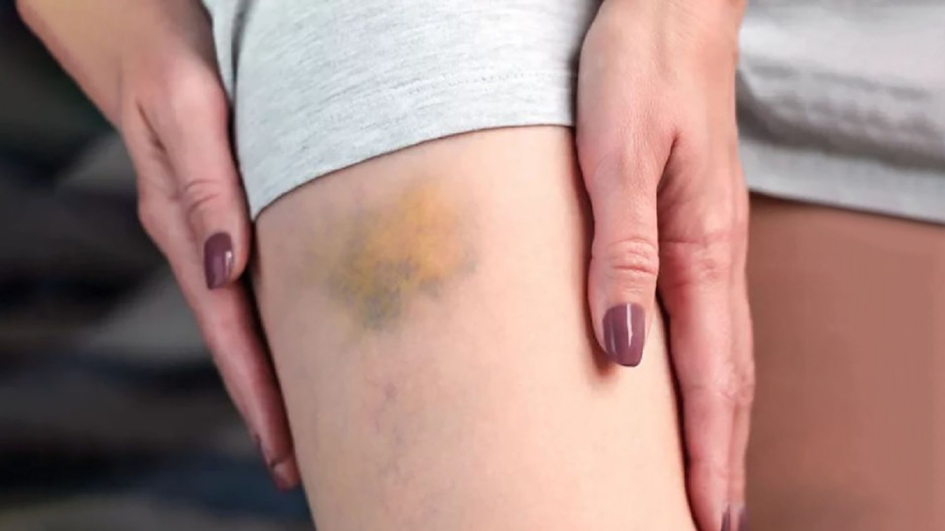 Bầm tím không rõ nguyên nhân là dấu hiệu nhận biết sớm trẻ mắc bệnh máu khó đông