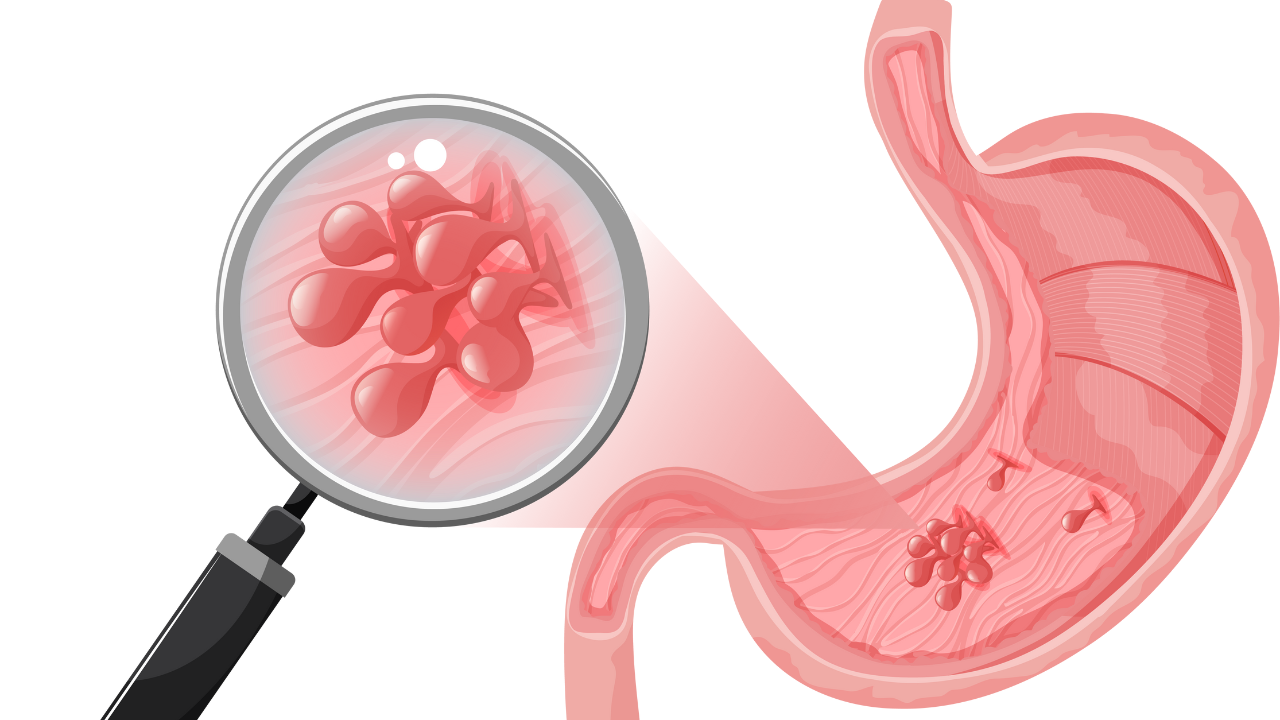 Bệnh nhân bị polyp dạ dày có nguy hiểm không​? 4