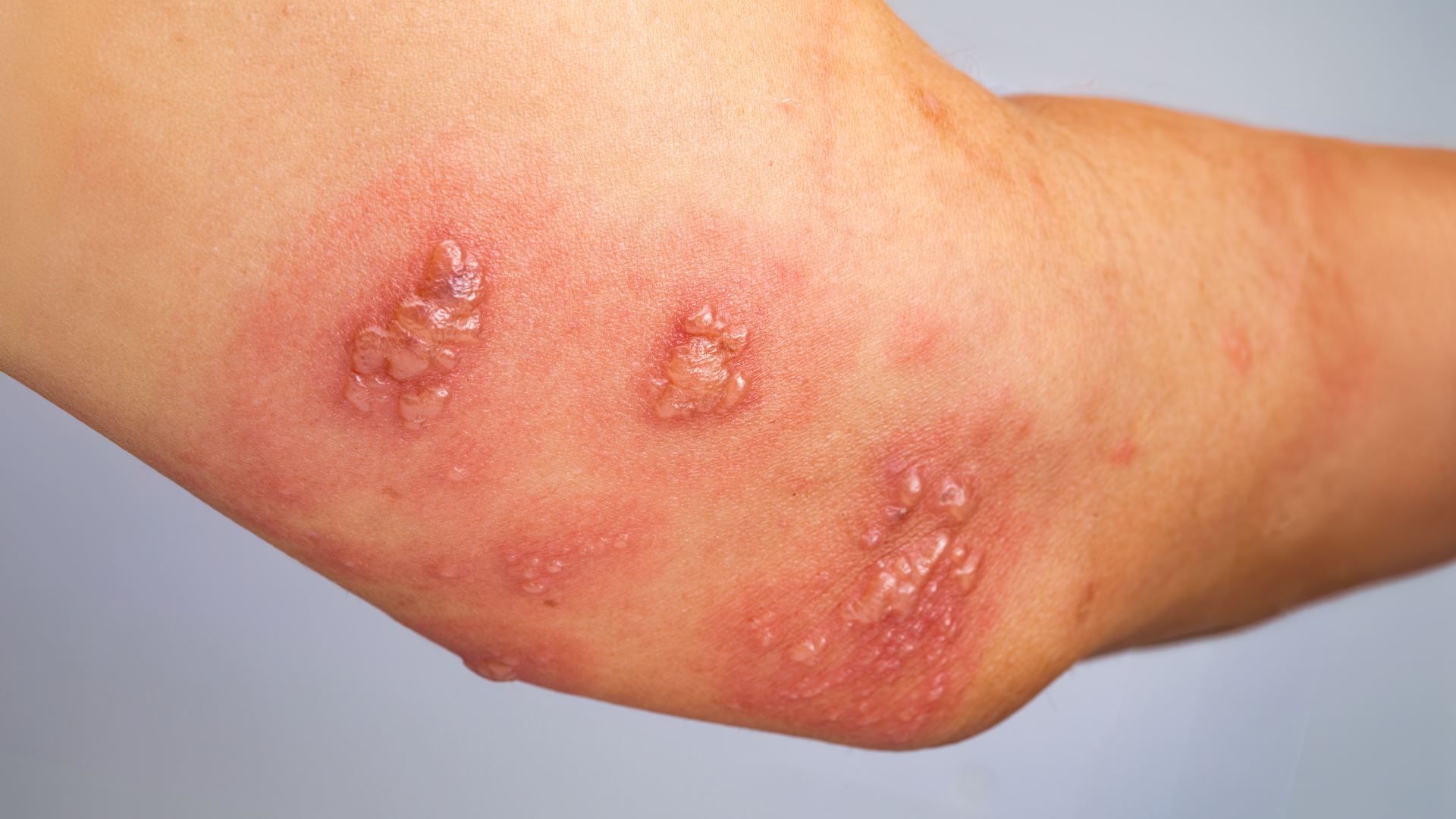 Bệnh pemphigus có thể kèm theo triệu chứng toàn thân