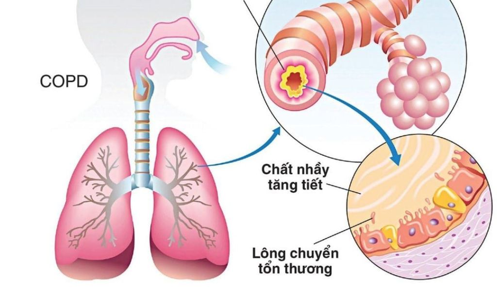 Bệnh phổi tắc nghẽn mạn tính có lây không? Hiểu đúng về COPD 1