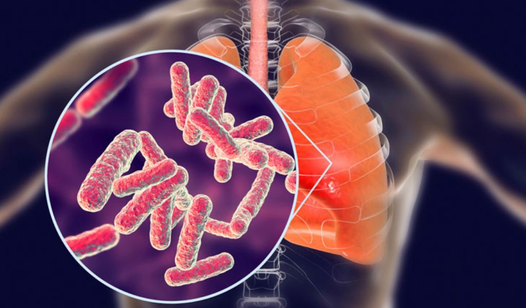 Bệnh phổi tắc nghẽn mạn tính có lây không? Hiểu đúng về COPD 3