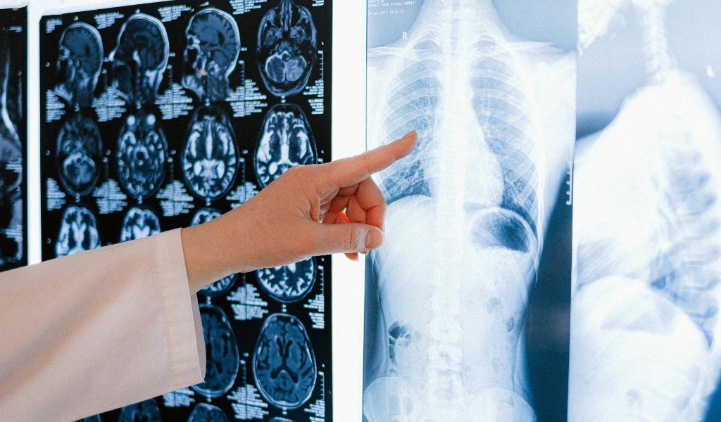 Bệnh phổi tắc nghẽn mạn tính giai đoạn 3 là gì? 3