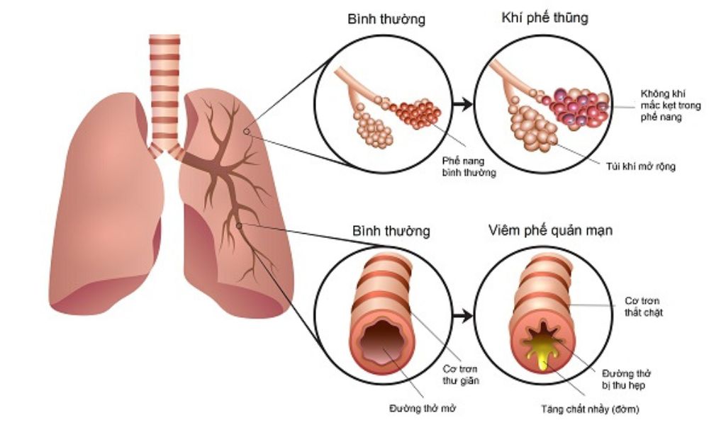 bệnh phổi tắc nghẽn mạn tính giai đoạn cuối và cách chăm sóc hiệu quả 1