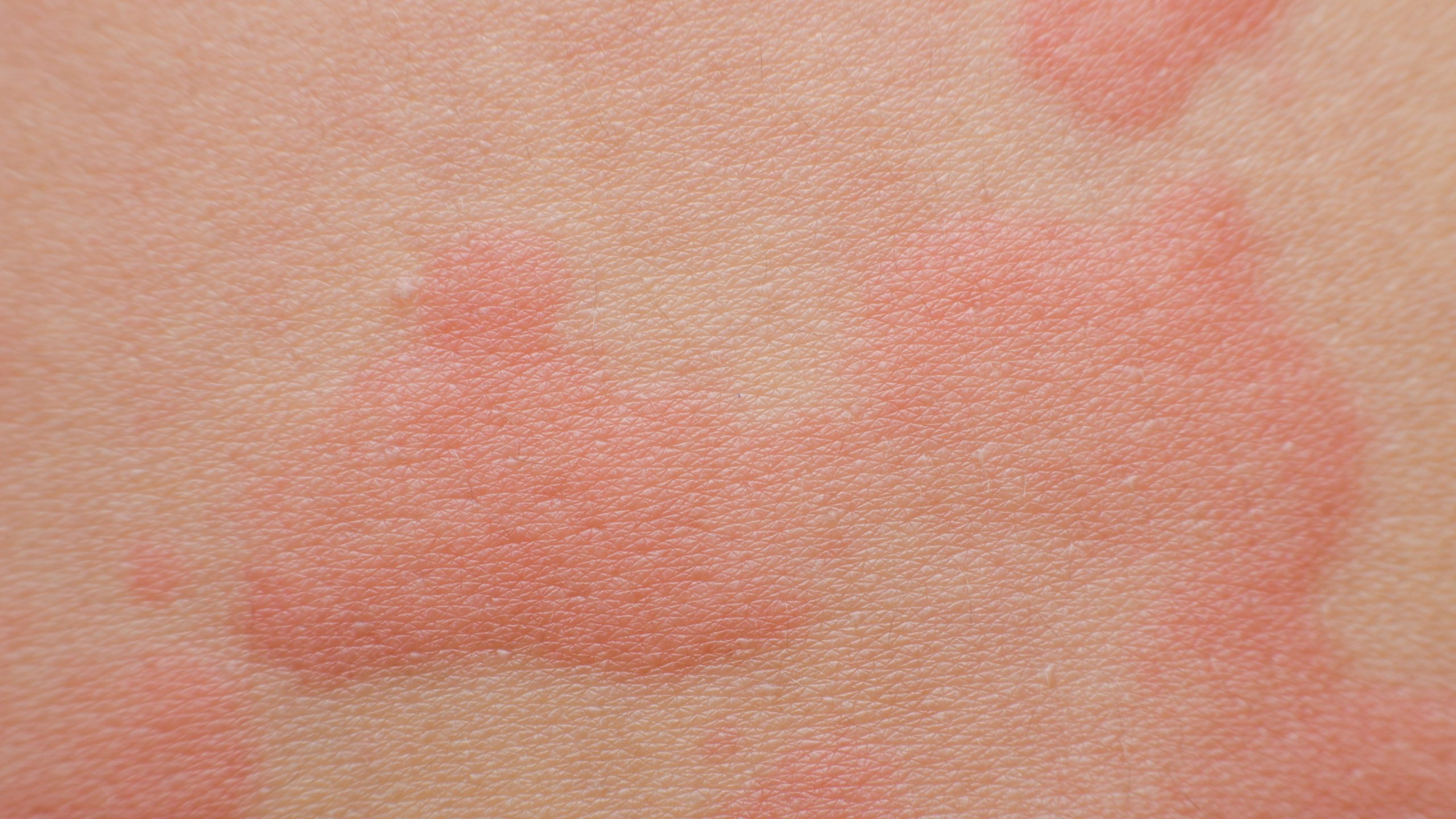 Các vết sẩn phù có thể nhỏ và tròn, hình vòng hoặc với hình dạng ngẫu nhiên