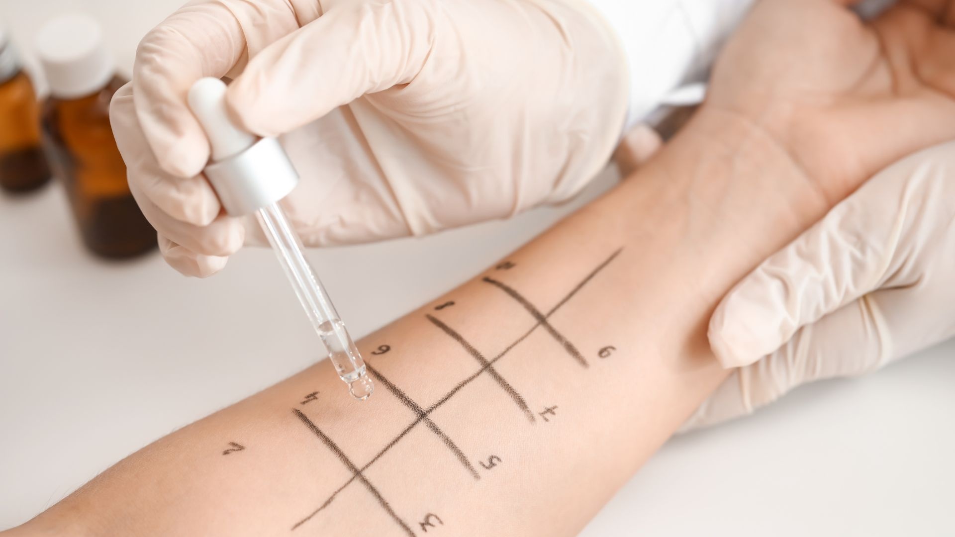 Test lẩy da giúp phát hiện các chất gây dị ứng khác nhau