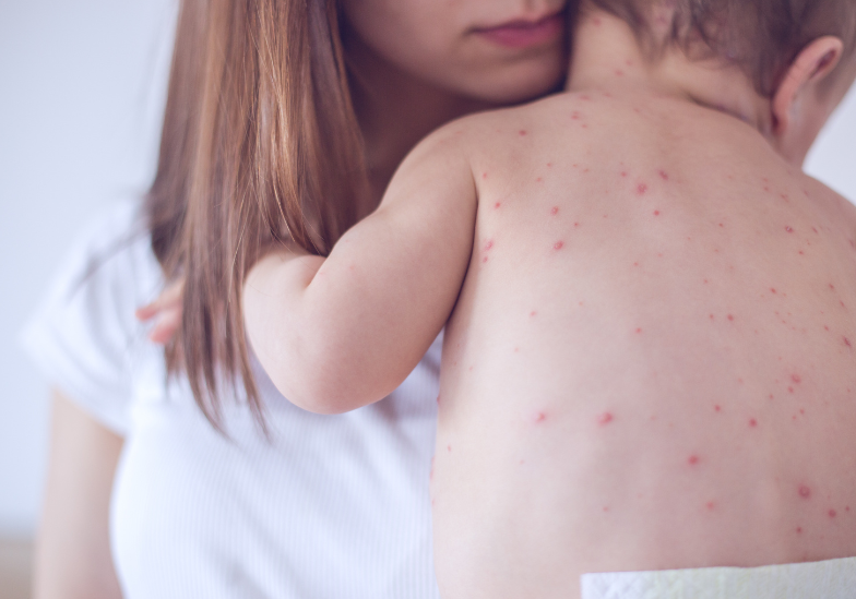 benh-soi-bi-may-lan-trong-doi 2.png