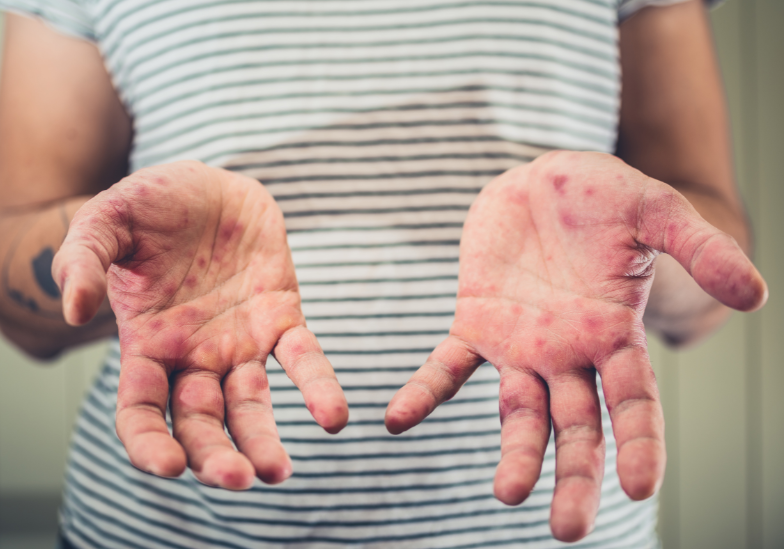 benh-soi-bi-may-lan-trong-doi 3.png