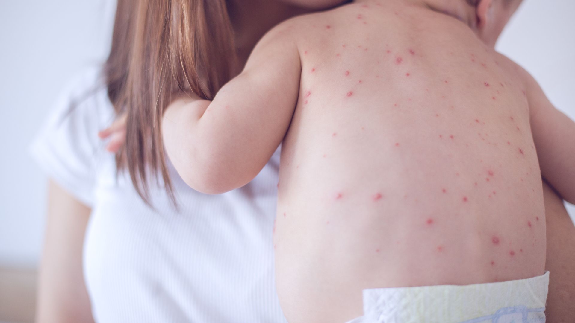 benh-soi-trieu-chung-nguyen-nhan-chan-doan-dieu-tri-va-phong-ngua 1.jpg