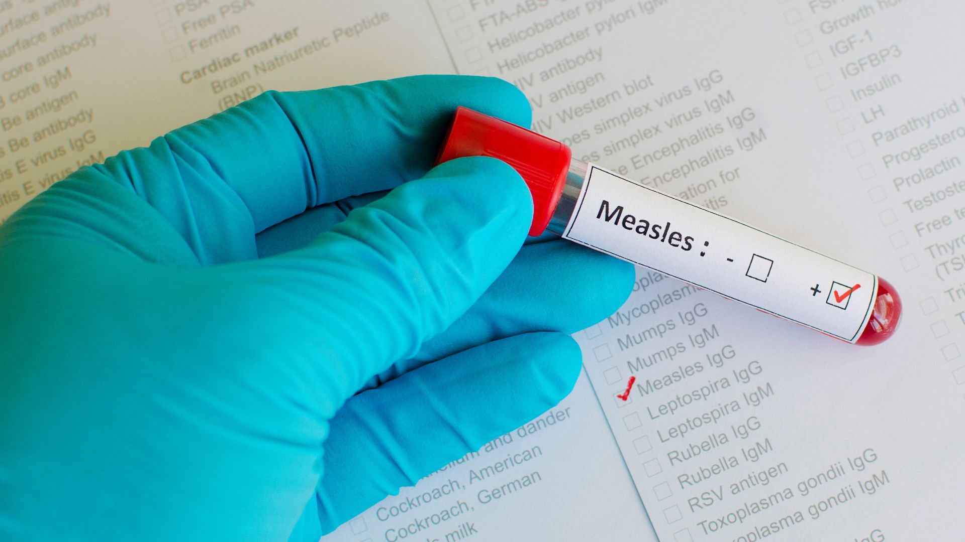 benh-soi-trieu-chung-nguyen-nhan-chan-doan-dieu-tri-va-phong-ngua 4.jpg