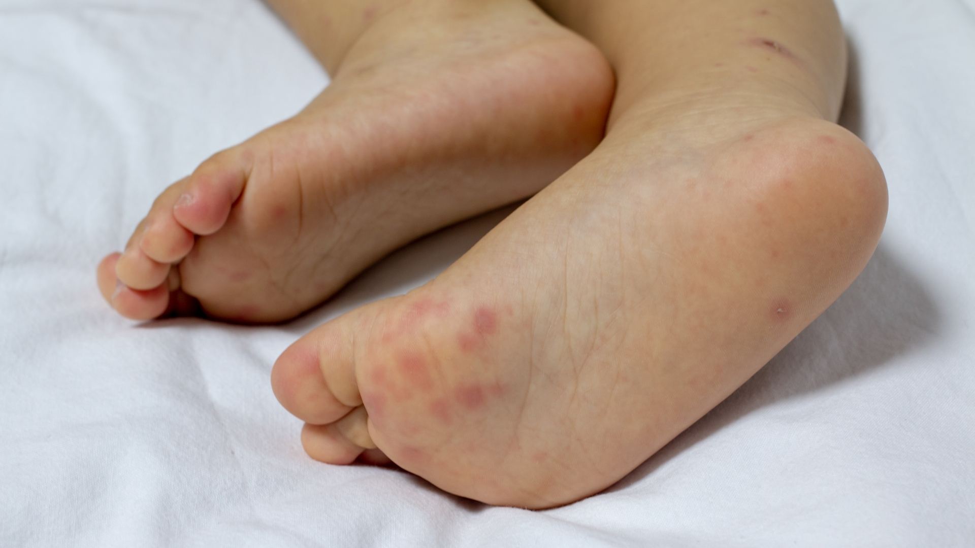 Bệnh tay chân miệng ngày thứ 3: Dấu hiệu, diễn biến và cách chăm sóc đúng cách 2