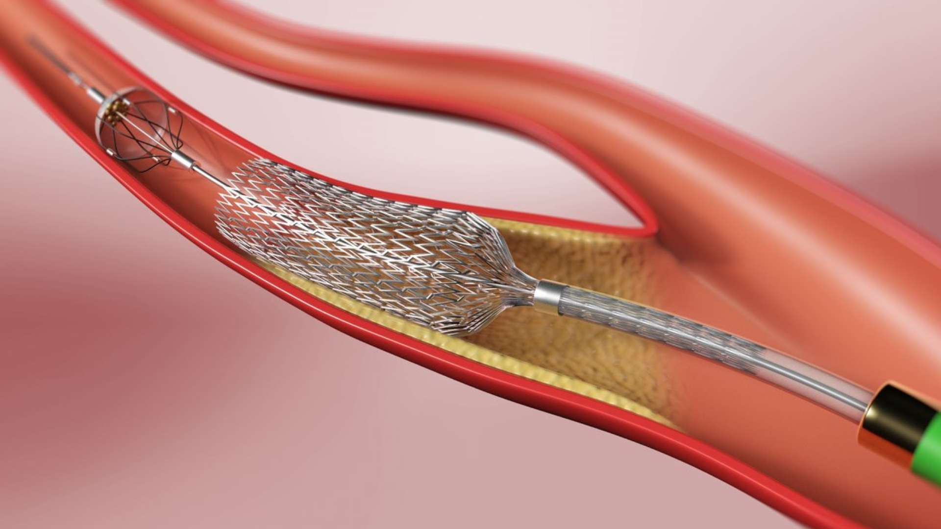 Stent nhỏ gọn nhưng hiệu quả, giữ cho dòng máu lưu thông trơn tru lên não, giảm nguy cơ tắc nghẽn mạch máu