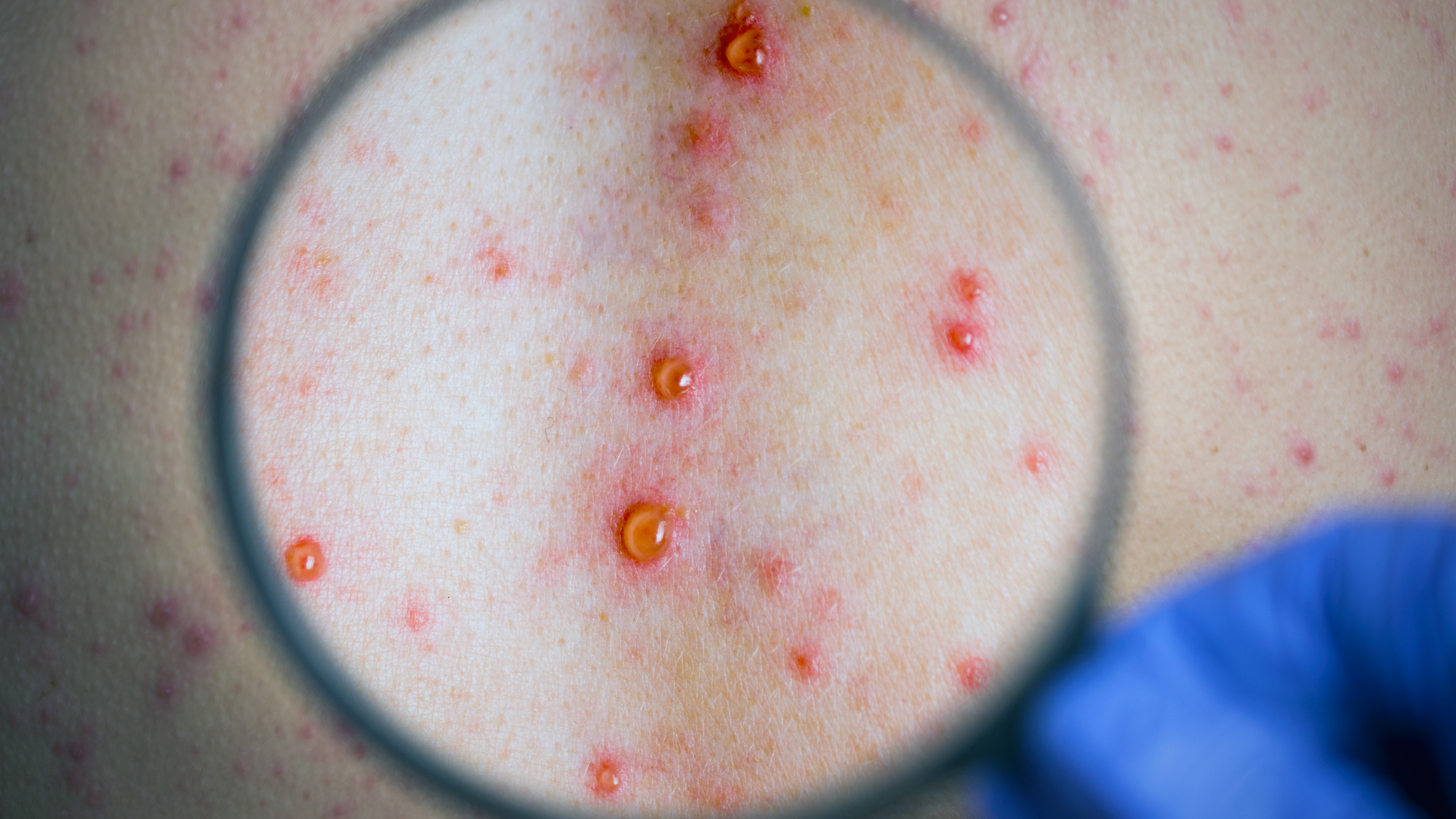 Trấn an đúng mức, hiểu rõ ngoại lệ hiếm để theo dõi kịp thời