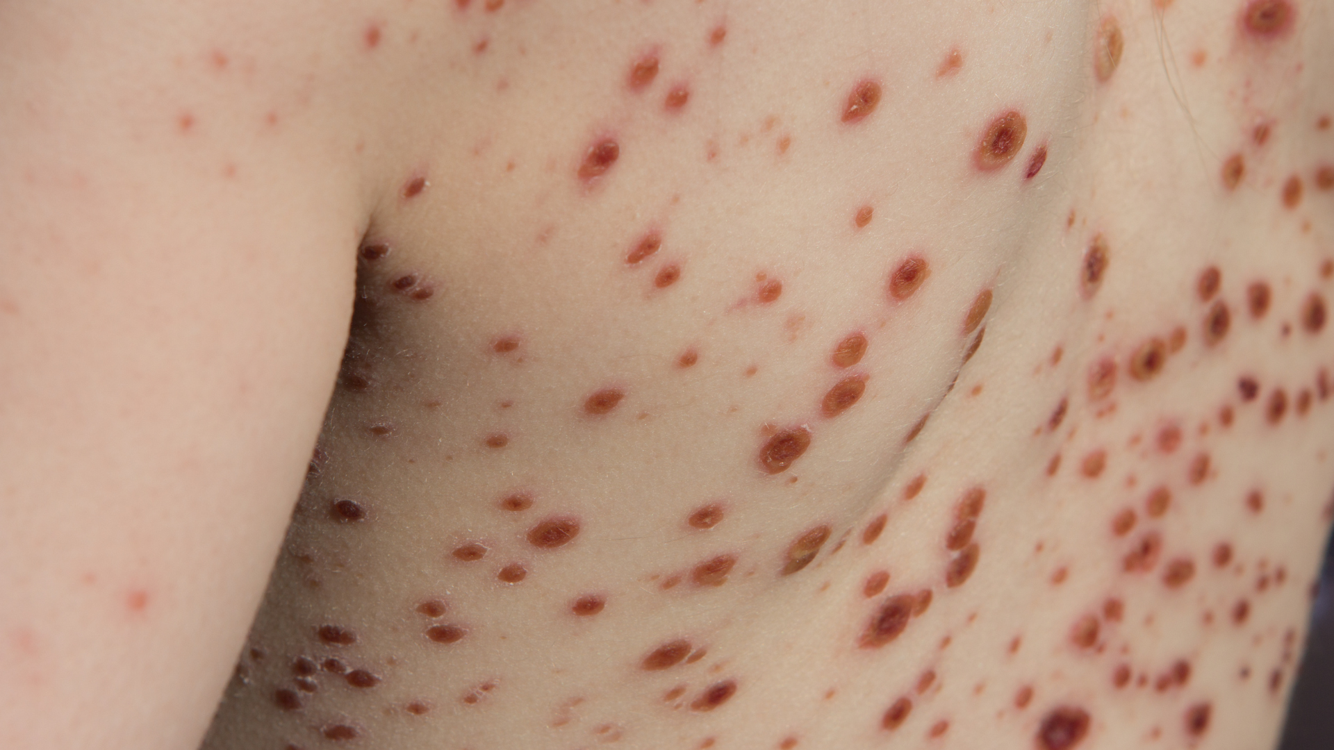 Bệnh thủy đậu có bị vô sinh không, xem kỹ các tình huống ngoại lệ