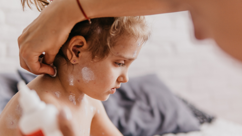 Cha mẹ cần theo dõi sát để phòng ngừa biến chứng nguy hiểm khi bệnh thủy đậu ở trẻ em dưới 1 tuổi