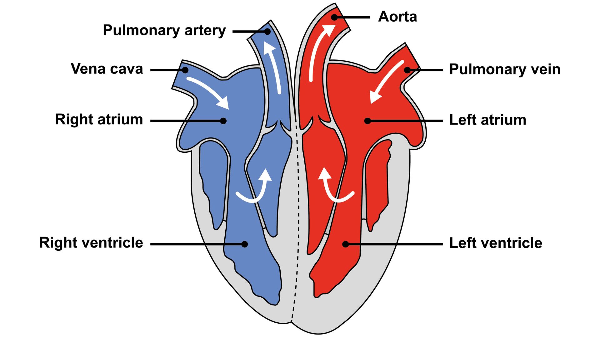 Nguyên nhân phổ biến nhất gây bệnh tim to là bệnh động mạch vành và tăng huyết áp kéo dài