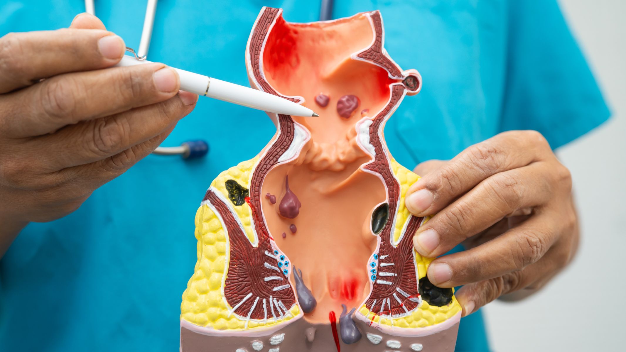 Khi áp lực trong ổ bụng tăng, các tĩnh mạch dễ bị giãn và dẫn đến hình thành búi trĩ