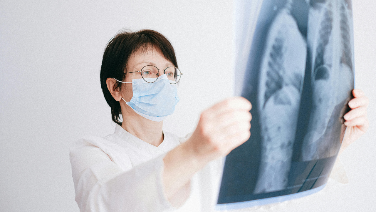 Bệnh ung thư phổi giai đoạn 1 sống được bao lâu? 3