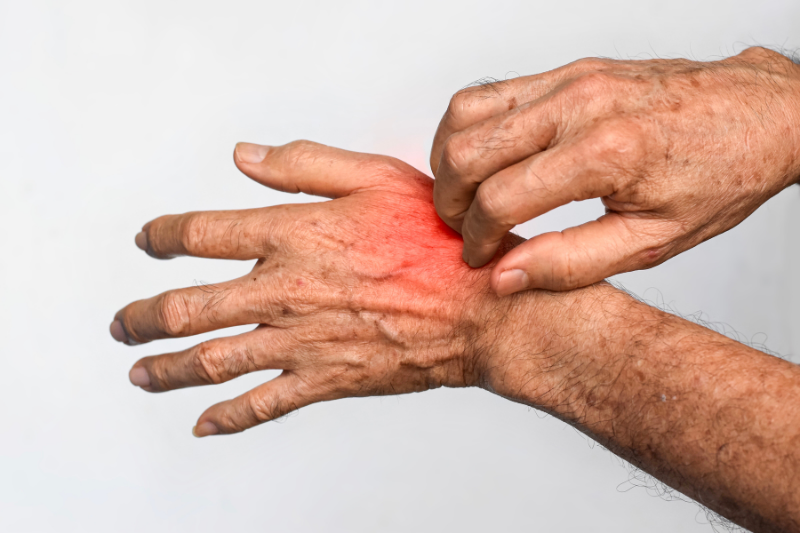 Ngứa, bong da,... là những biểu hiện thường gặp của bệnh vẩy nến thể nhẹ