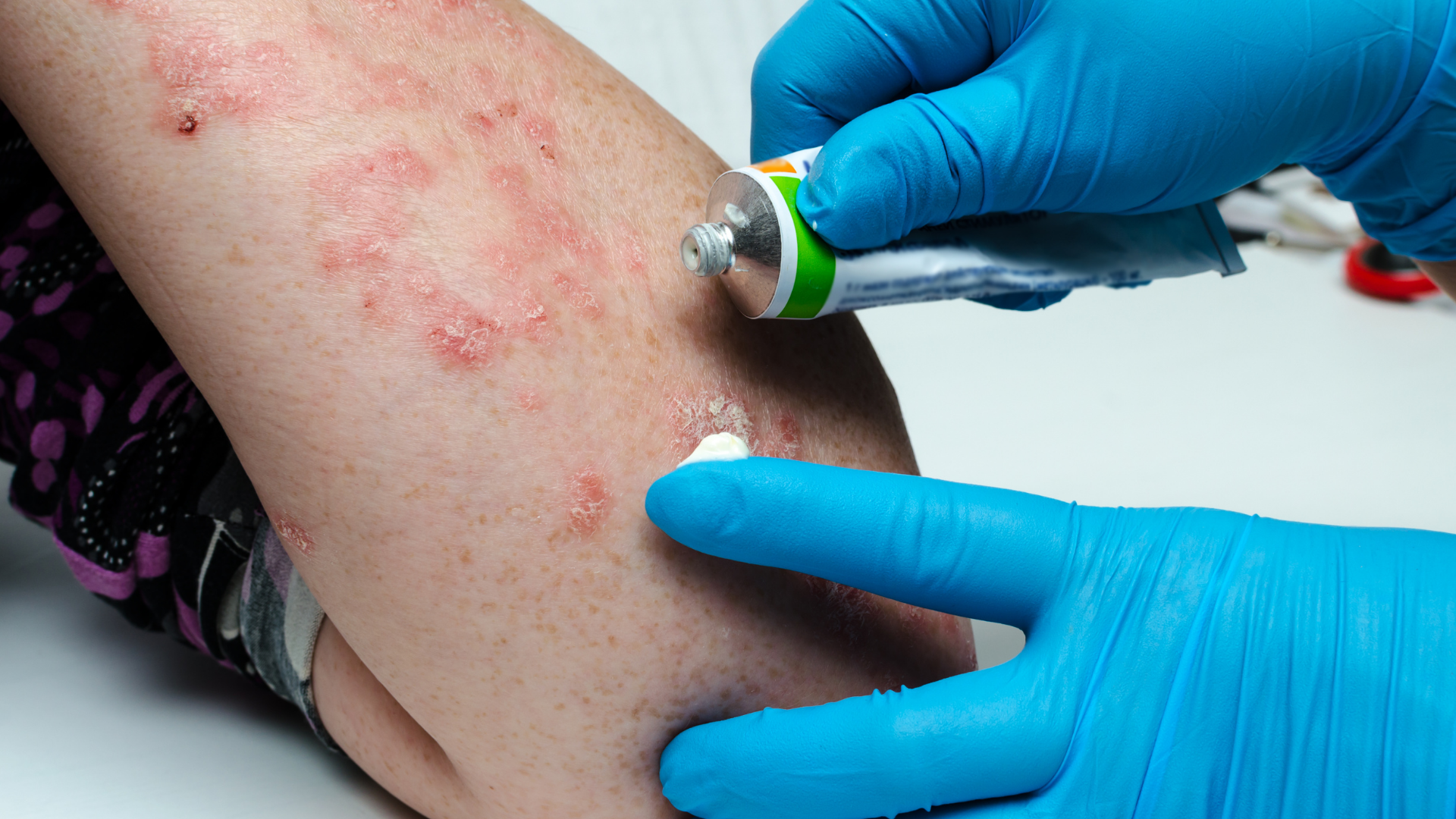 Chăm sóc da thường xuyên để cải thiện tình trạng vẩy nến nhẹ