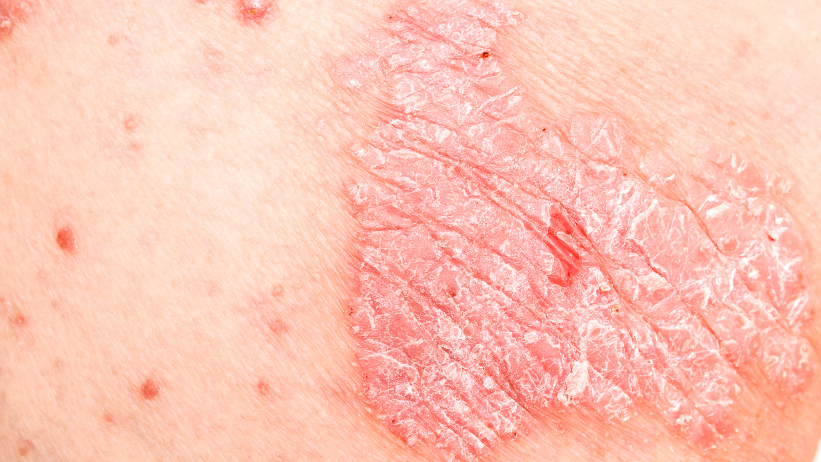 Bệnh vảy nến ở chân xảy ra khi hệ miễn dịch tấn công nhầm các tế bào da khỏe mạnh, khiến chúng tái tạo nhanh gấp 10 lần bình thường