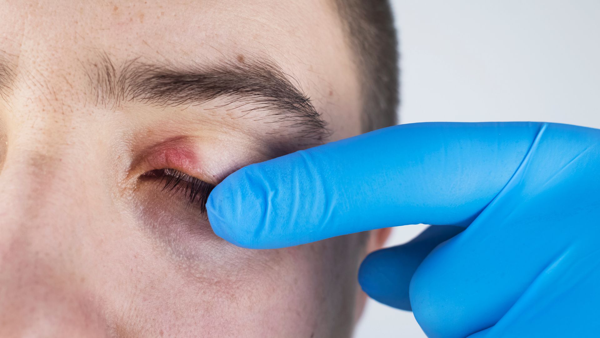 Viêm bờ mi là tình trạng viêm tại mép mí mắt, nơi có các tuyến nhờn tiết dầu giúp bôi trơn và bảo vệ mắt